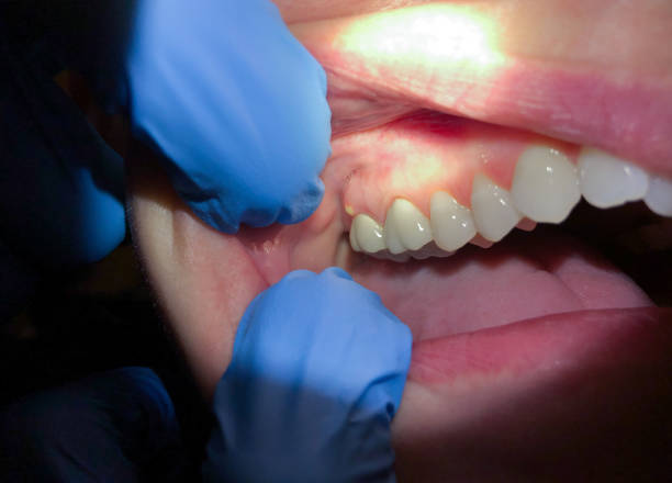 Best Emergency Tooth Extraction in Macom, IL